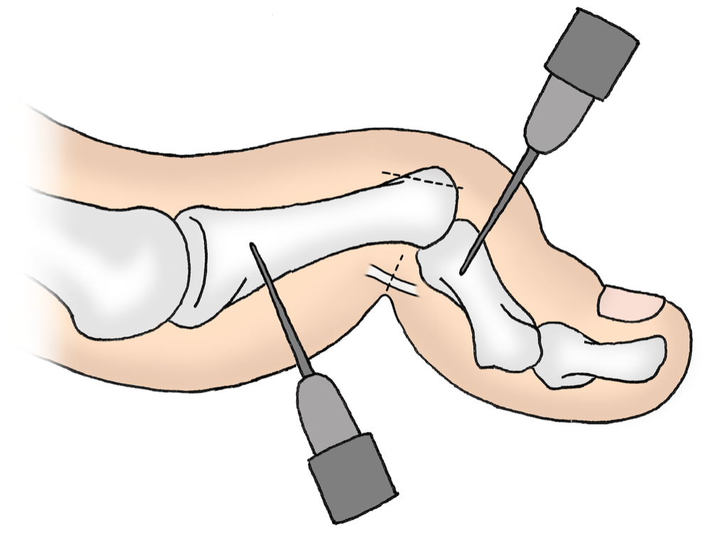 Hallux valgus und Hammerzehen KlinikImpuls